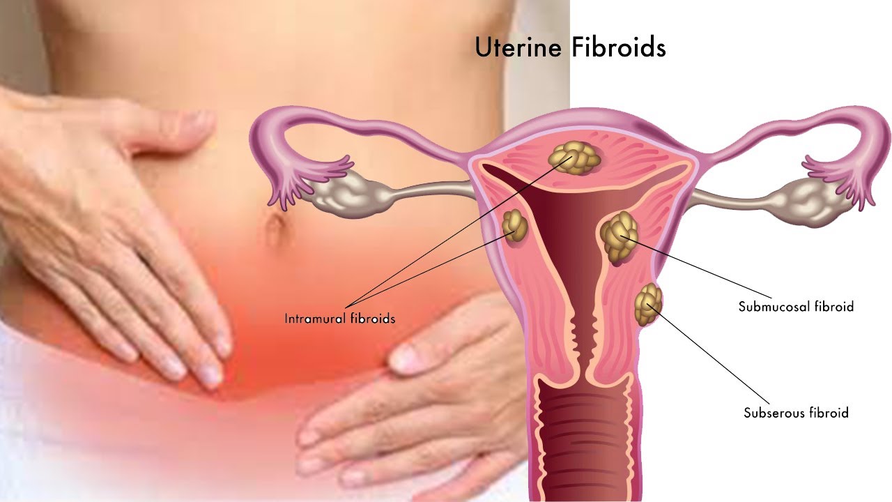 fibroids